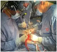 ecmo cannulation