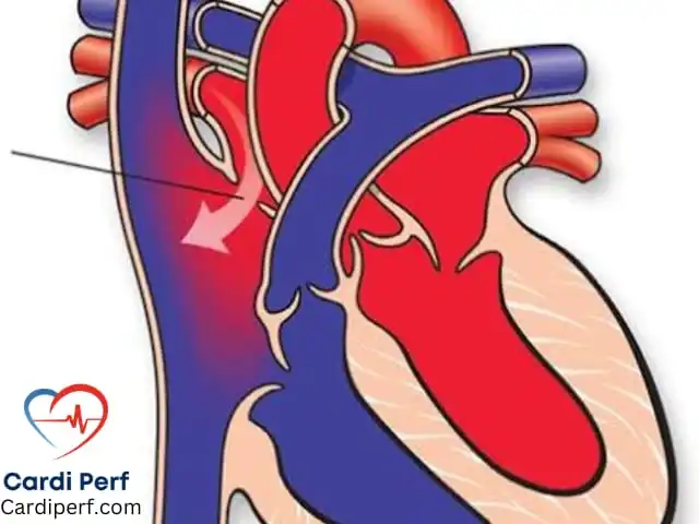 Atrial Septal Defect (ASD)