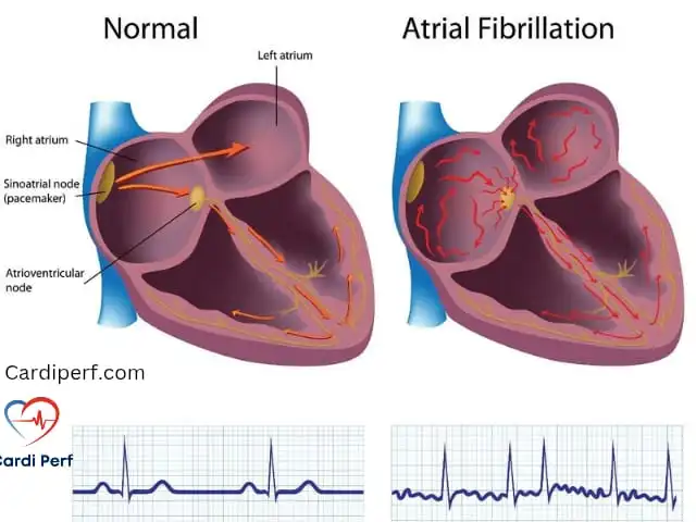 Atrial Fibrillation