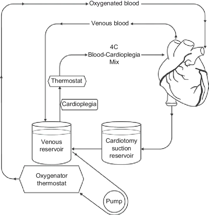 Diagram of a cardiopulmonary bypass (CPB) circuit showing the blood flow path, including labeled components like the oxygenator, pump, and cannulas.