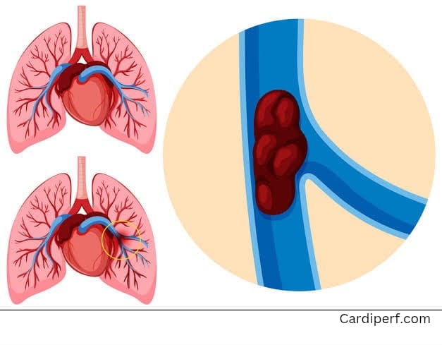 pulmonary embolism