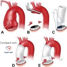 bentall Procedure