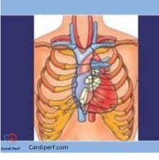 myocardial protection