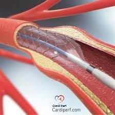 Angiography vs. Angioplasty - Understanding the Differences