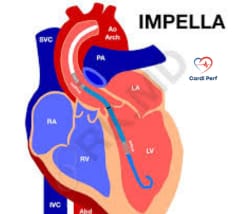 3D-rendered image of the Impella heart pump inside the left ventricle, demonstrating blood flow support in cardiogenic shock.