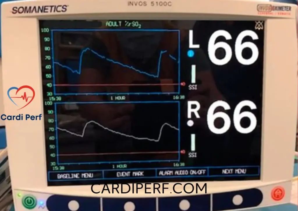 Perfusionists examining NIRS cerebral oxygenation readings on a monitor during cardiopulmonary bypass in a cardiac surgery setting.