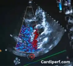 Grayscale echocardiogram showing the four chambers of the heart: left atrium, left ventricle, right atrium, and right ventricle.